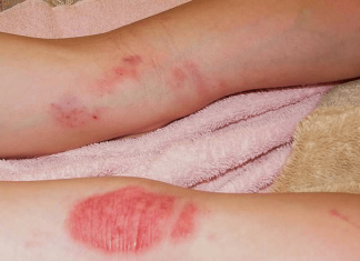 Eczema vs Psoriasis